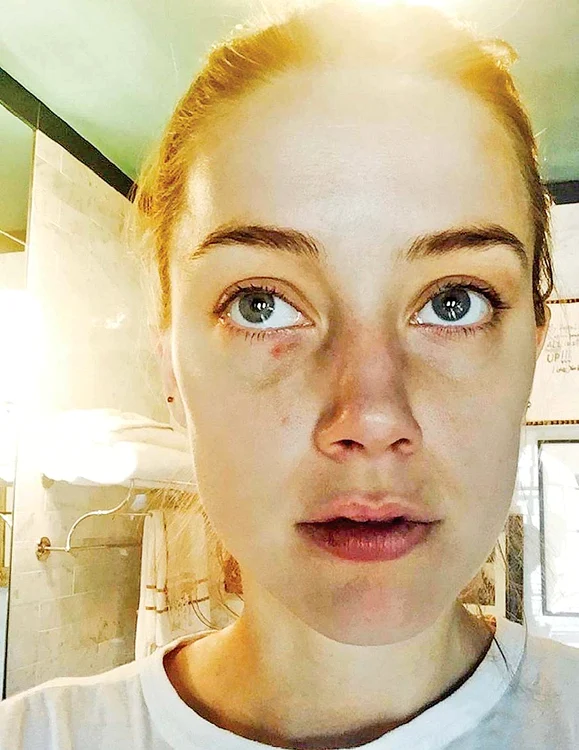 Amber Heard l-a acuzat de nenumărate ori că o umplea de vânătăi