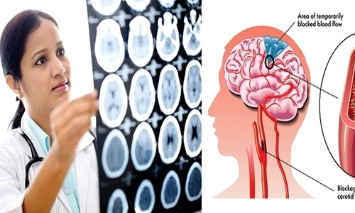 1 durerea ta de cap poate fi fatala uite la ce semne trebuie sa fii atenta ny2n jpg jpeg