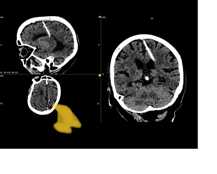 Medicii au găsit un ac în creierul unei femei. Foto: Sackhalin of Ministry of Health