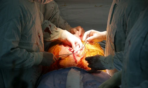 operatie plamani piept torace medici foto shutterstock