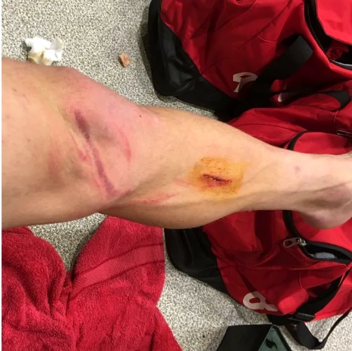 Aşa arată piciorul lui Vali Lazărfoto: arhivă personală