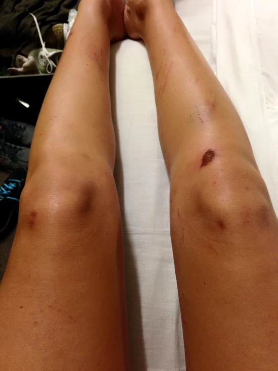 Aşa arătau picioarele Denisei după o săptămână de antrenament la "Şerifi de România"