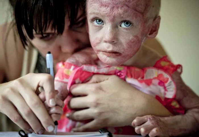 Pippie, după operaţia de transplant de piele. Fata are acum şase ani şi refacerea decurge aşa cum trebuie