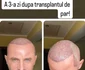 Sorin Brotnei a făcut cel de-al doilea transplant de păr foto: Instagram