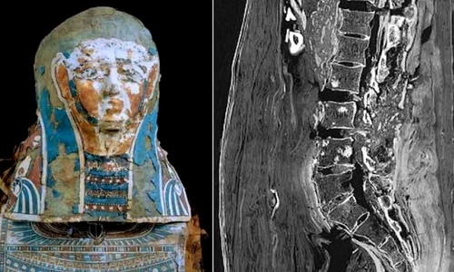 Cel mai vechi caz de cancer la prostatã din Egipt jpeg