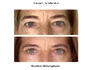 rezultat blefaroplastie iancu morad luxury aesthetics 10 jpg