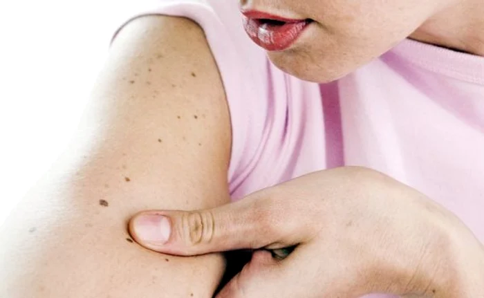 Dacă ai multe aluniţe pe corp, recomandat e să mergi la medicul dermatolog o dată pe an pentru un control de rutină
