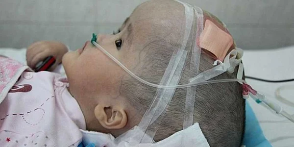 hanhan transplant cap cutie craniana
