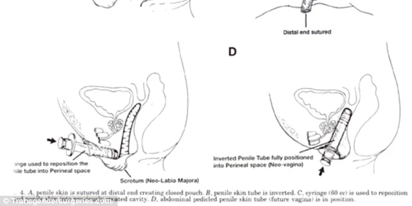 vaginoplastie grafic