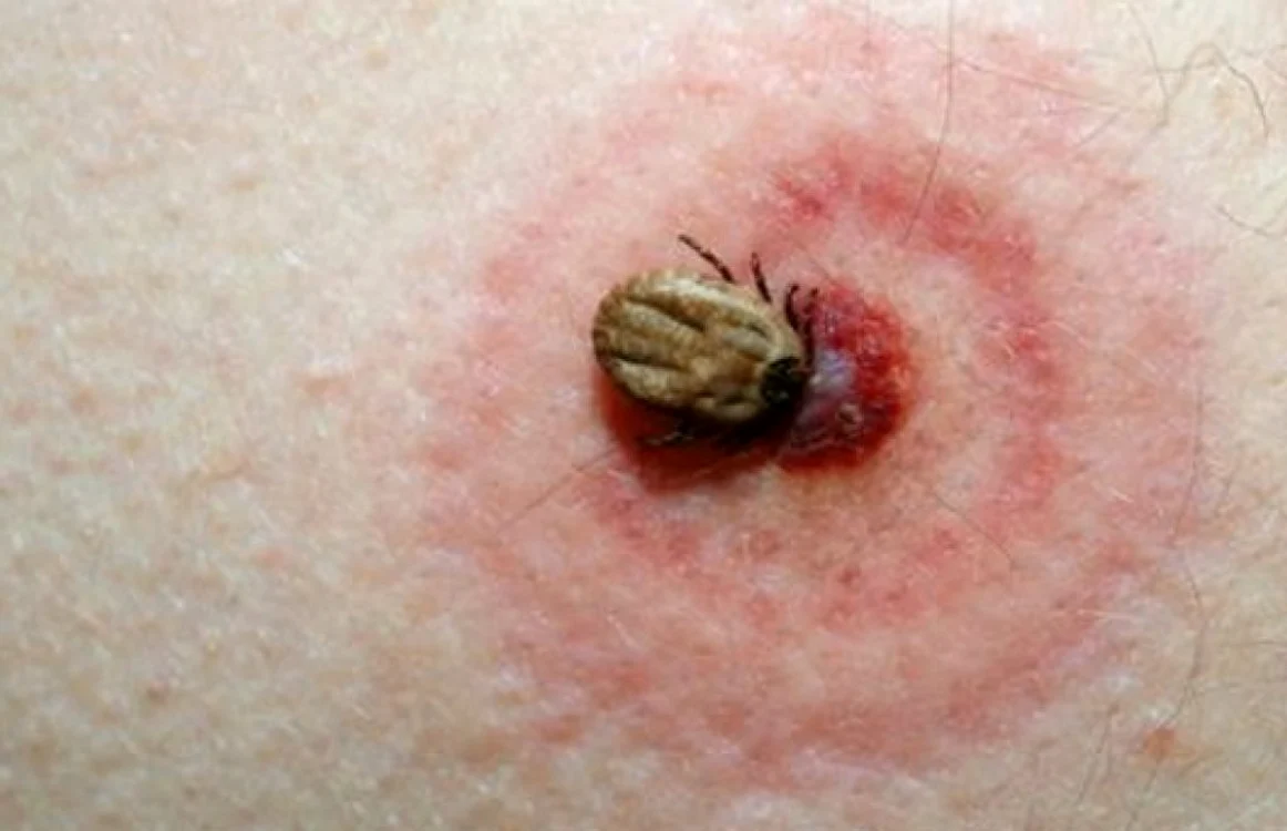 Dacă aţi fost muşcat de căpuşe, mergeţi de urgenţă la medic FOTO Adevărul