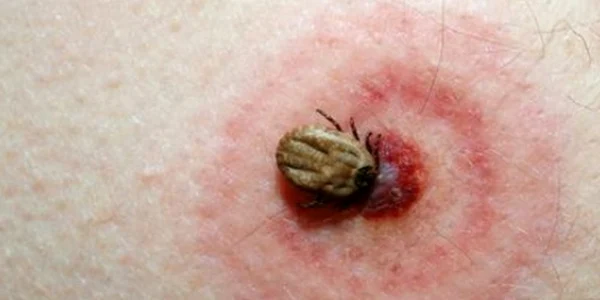 Muşcătură, la o persoană afectată de "isteria căpuşelor"