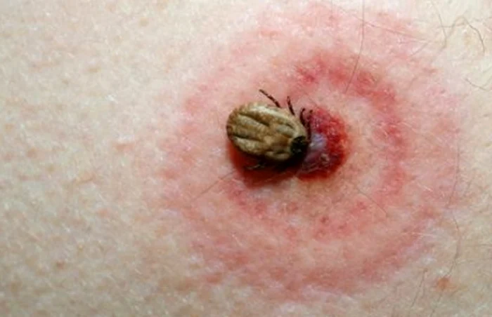 Muşcăturile de căpuşe pot provoca boli infecţioase grave