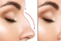 rinoplastie jpg