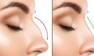 rinoplastie jpg