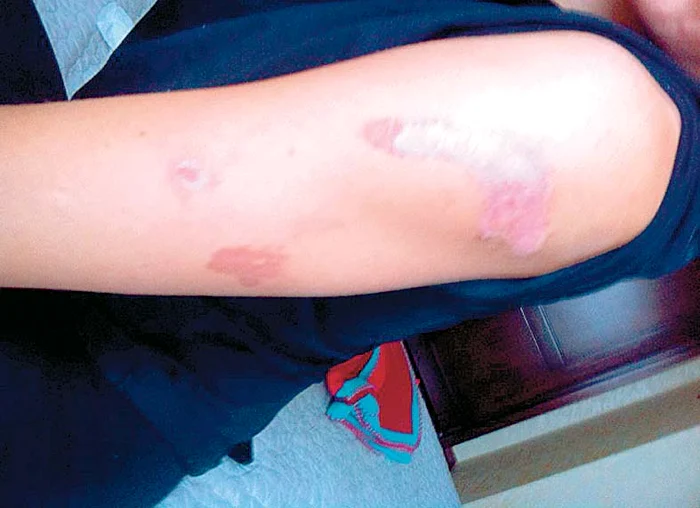 Aşa arăta braţul Emanuelei în seara în care a fost opărită