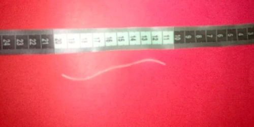 Viermele de opt centimetri a fost scos din ochiul bărbatului în urma unei operaţii