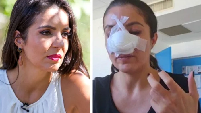 4 cristina joia operata la nas 2 jpg jpeg