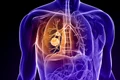 Cancer pulmonar Foto Cancer Treatment Centers of America dms jpg