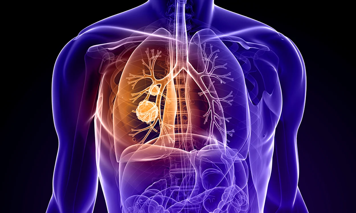Un nou test ar detecta cancerul pulmonar FOTO: Cancer Treatment Centers of America