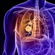 Cancer pulmonar Foto Cancer Treatment Centers of America dms jpg