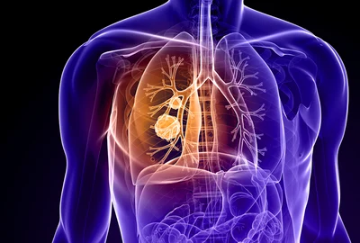 Cancer pulmonar Foto Cancer Treatment Centers of America dms jpg