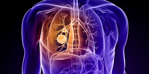 Cancer pulmonar Foto Cancer Treatment Centers of America dms jpg