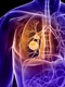 Cancer pulmonar Foto Cancer Treatment Centers of America dms jpg