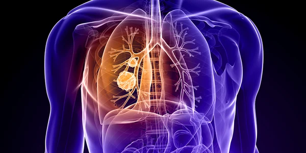Cancer pulmonar Foto Cancer Treatment Centers of America dms jpg