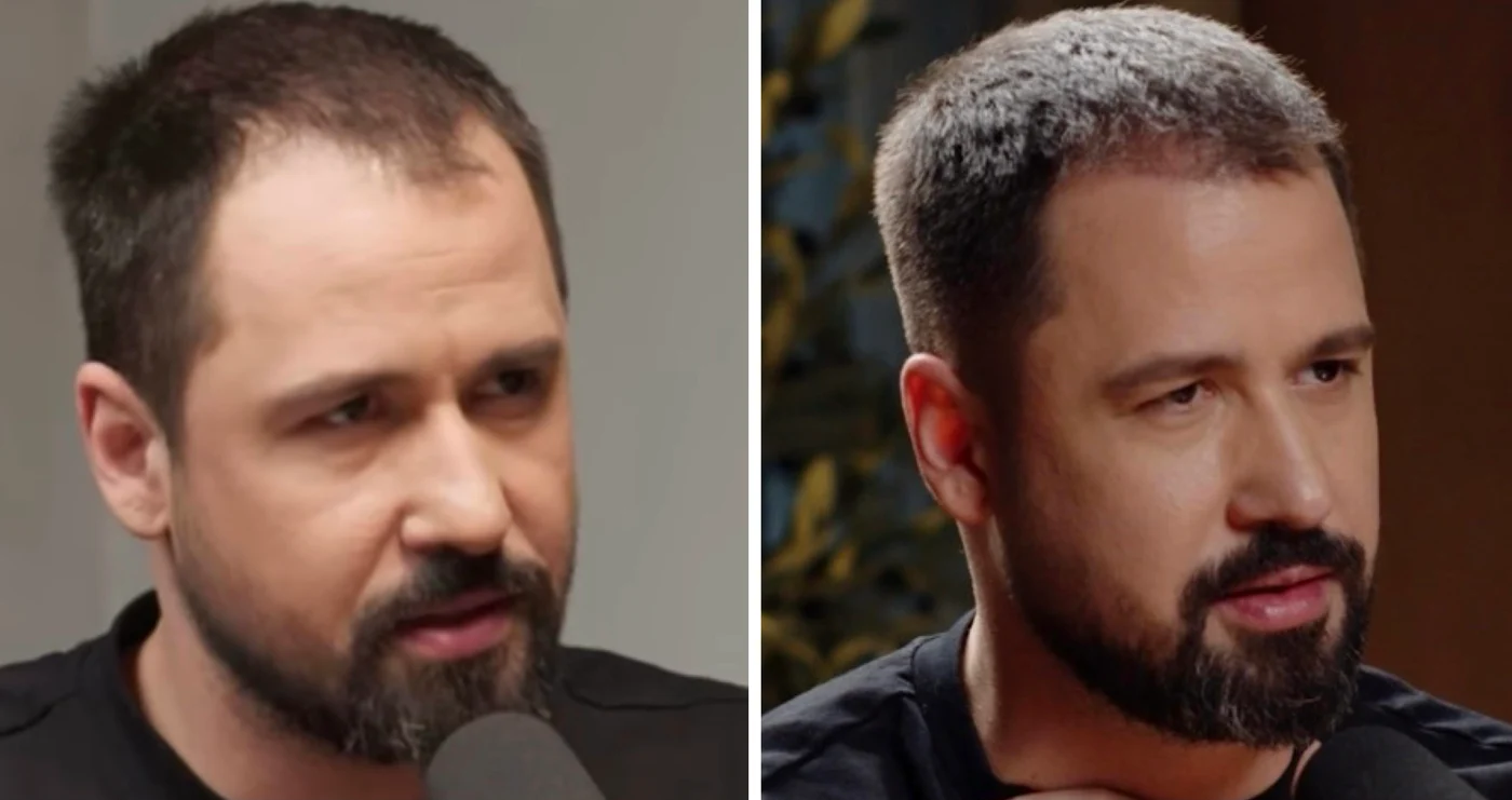 Alexandru Constantin, înainte și după implantul de păr foto: Click!