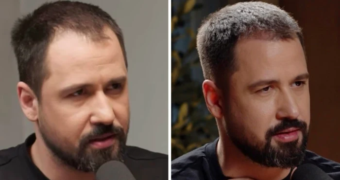 Alexandru Constantin, înainte și după implantul de păr foto: Click!