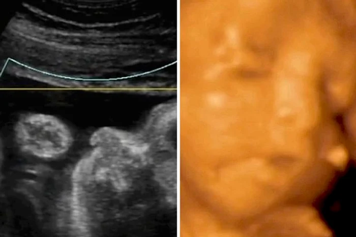 
    Difereța uimitoare dintre ecografia 3D și cea 4D provoacă emoție oricărei mame înainte de a naștefoto: mirorr.uk.co  