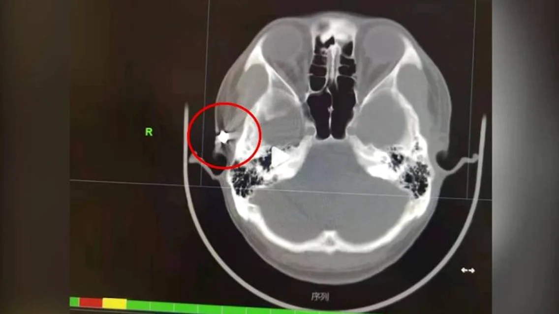 Radiografie barbat cu glont in craniu jpg