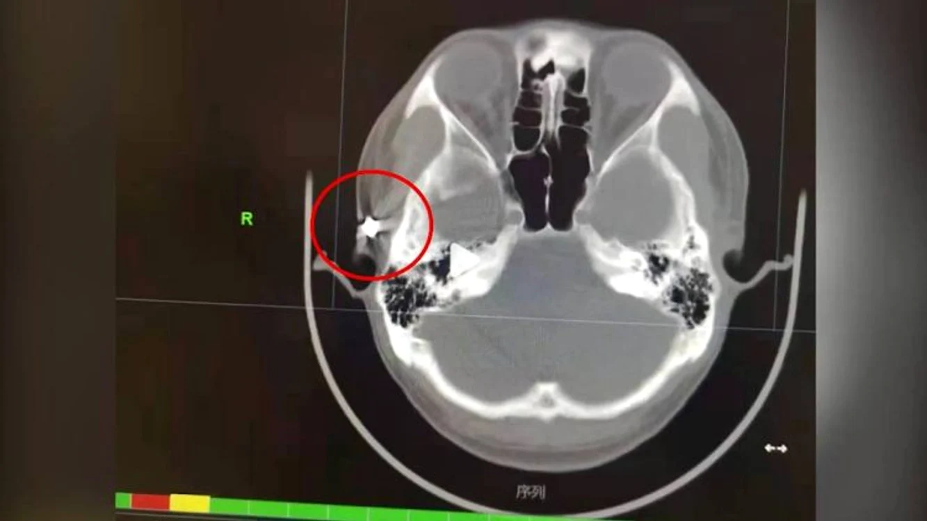 Radiografie barbat cu glont in craniu jpg