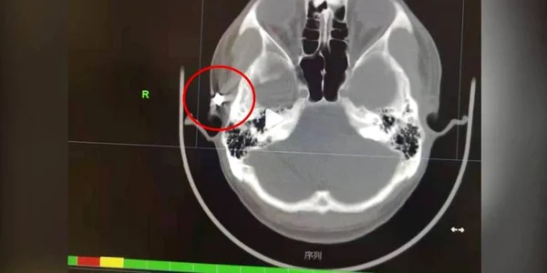 Radiografie barbat cu glont in craniu jpg