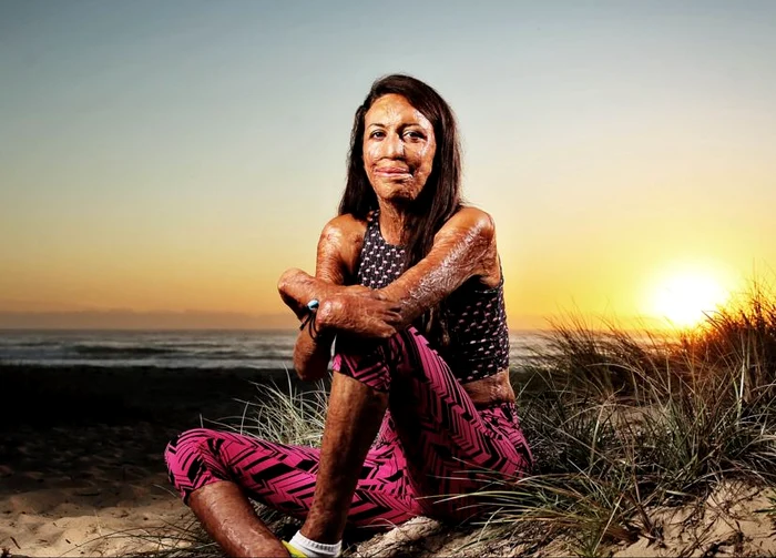 
    Turia Pitt, o atletă care a suferit arsuri pe 65 % din suprafața corpului, revine la pasiunea ei participând la un triatlon Ironman.foto: Guliver/Rex Features  