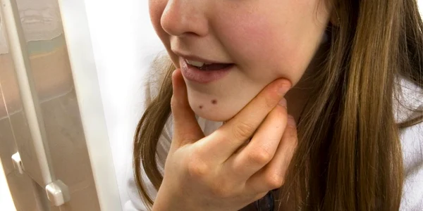 Deoarece se localizează îndeosebi la nivelul feţei, acneea este considerată una dintre cele mai traumatizante afecţiuni de piele