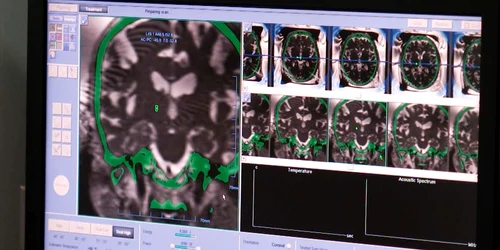 cnn  Ultrasunete focalizate jpg