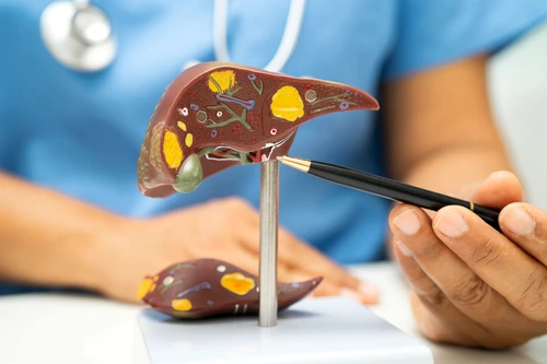 Atenție, așa se poate transforma ficatul gras în cancer!