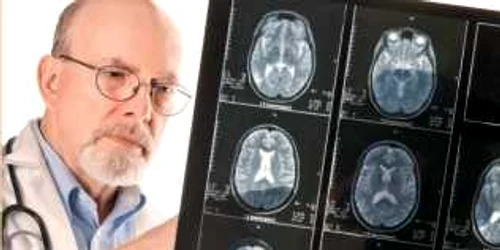 Noua procedură permite depistarea bolii  Alzheimer cu peste zece ani înainte de apariţia  primelor simptome