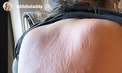 adda alergii jpeg