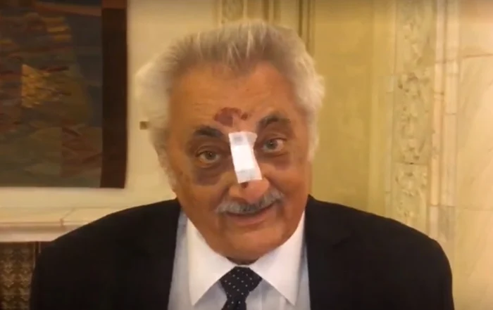 
    Deputatul PSD Nicolae Bacalbașa (74 ani) a șocat luni, 15 octombrie, când a apărut la Palatul Parlamentului cu nasul rupt și plin de vânătăi pe fațăFOTO: adevarul.ro  