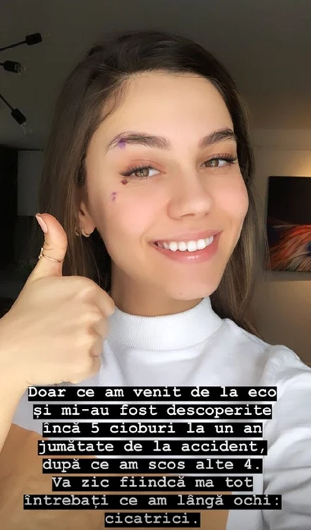 Mira a mărturisit că și acum, la un an și jumătate de la accident, a rămas cu cioburi în față