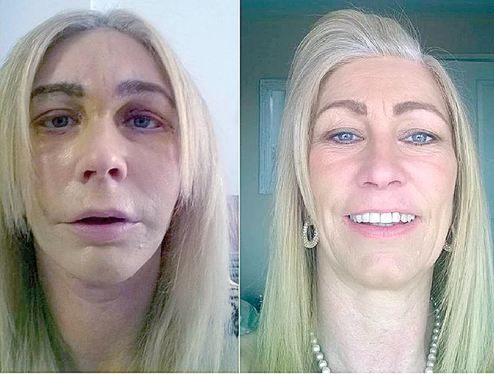 Înainte. Era pufoasă de la  injecţiile cu Botox. După. Se mândreşte cu  chipul ei întinerit 