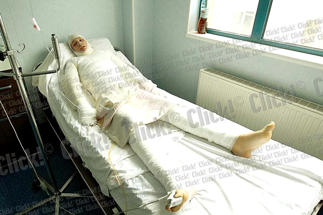 David a suferit arsuri pe faţă şi pe piept (Fotografii: Dorin Constanda)