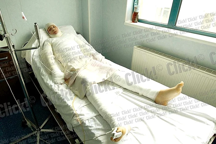 David a suferit arsuri pe faţă şi pe piept (Fotografii: Dorin Constanda)