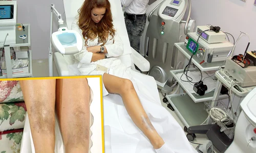 Aşa arată în realitate picioarele Biancăi  Drăguşanu  Vânătăile  îi vor aminti pentru  totdeauna de relaţia  tensionată cu Coco Păun jpeg