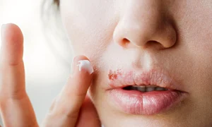 1 herpes bucal jpg jpeg