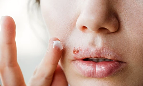 1 herpes bucal jpg jpeg