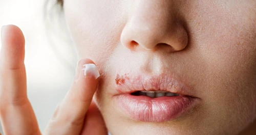 1 herpes bucal jpg jpeg