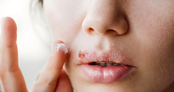 1 herpes bucal jpg jpeg